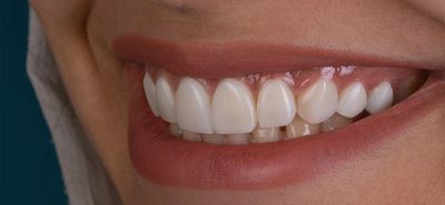 Sind Zahnfleischwucherungen gefährlich? Erfahren Sie, welche Symptome, Ursachen und Therapie ...