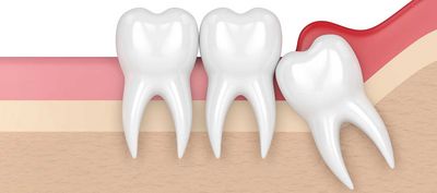 DentNet Ratgeber - Perikoronitis – Schlupfwinkelinfektion