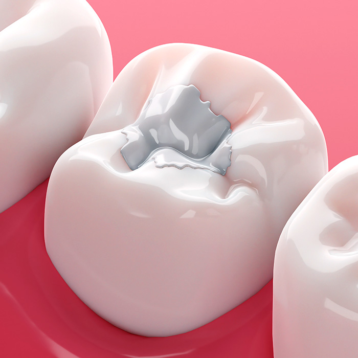 DentNet Zahnfuellung Kompositfuellung Karies