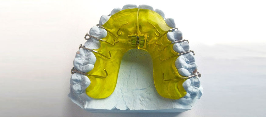 Herausnehmbare Zahnspangen zur Kieferregulation