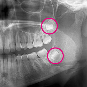 Was sind Weisheitszähne?